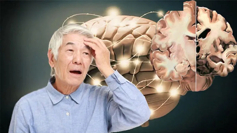 Bệnh Alzheimer là gì? Triệu chứng và nguyên nhân gây bệnh