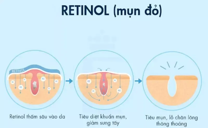 Các hoạt chất trị mụn, phục hồi da hiệu quả nên biết