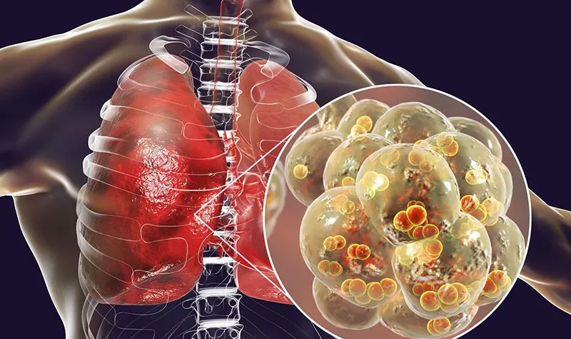 Interleukin 6 là gì? Có vai trò thế nào trong các phản ứng viêm?