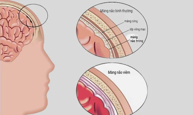 Interleukin 6 là gì? Có vai trò thế nào trong các phản ứng viêm?