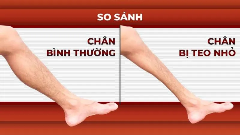 Mô tả đám rối thần kinh thắt lưng: Khái niệm, triệu chứng, chẩn đoán và điều trị