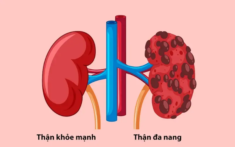 Ngày Thận thế giới là ngày gì? Các thói quen lành mạnh giúp bảo vệ sức khỏe thận