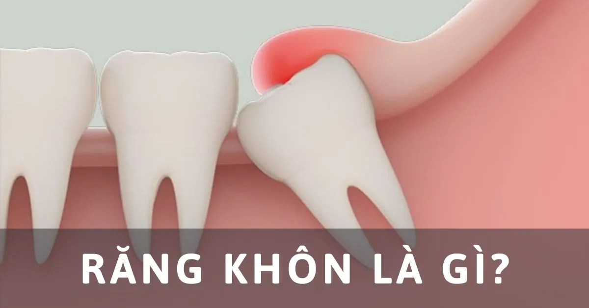 Răng khôn là gì? Các lưu ý về nhổ răng khôn mà bạn cần biết