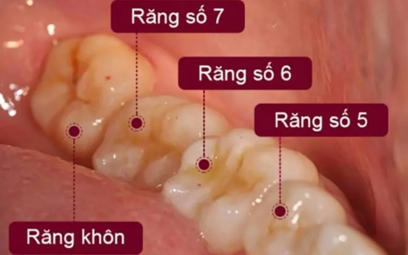 Răng khôn là gì? Các lưu ý về nhổ răng khôn mà bạn cần biết