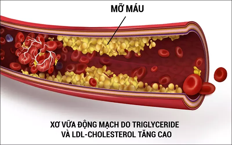 Triglyceride là gì? Tìm hiểu xét nghiệm định lượng triglycerid